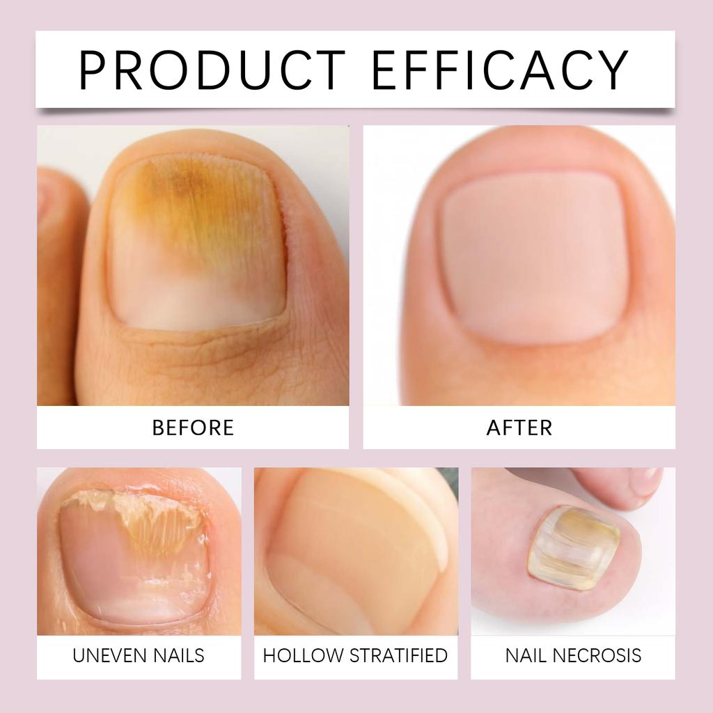 Nail Growth Serum Care Fungal Nail Pen For Restores The Healthy Appearance Of Nails Discolored Or Damaged By Fungus Nail (2ml)