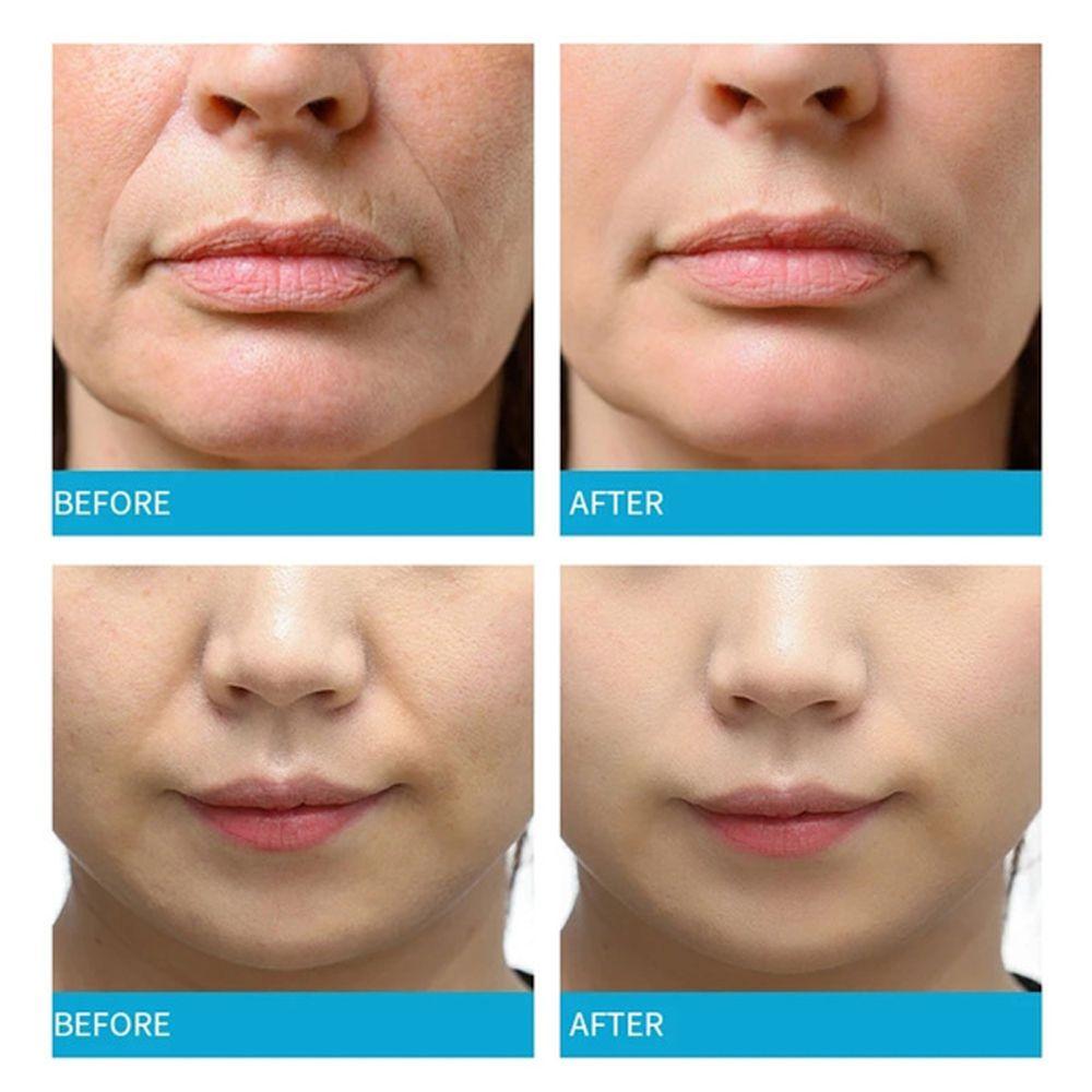 Buy Face Lines Forehead Lift Nasolabial Folds Facial Tape AntiWrinkle