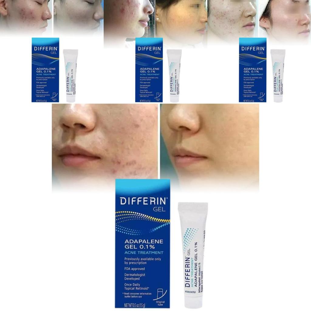 Differin Gel Traitement Acné Gel Rétinoïde Pour Peau Claire Radieuse 15g