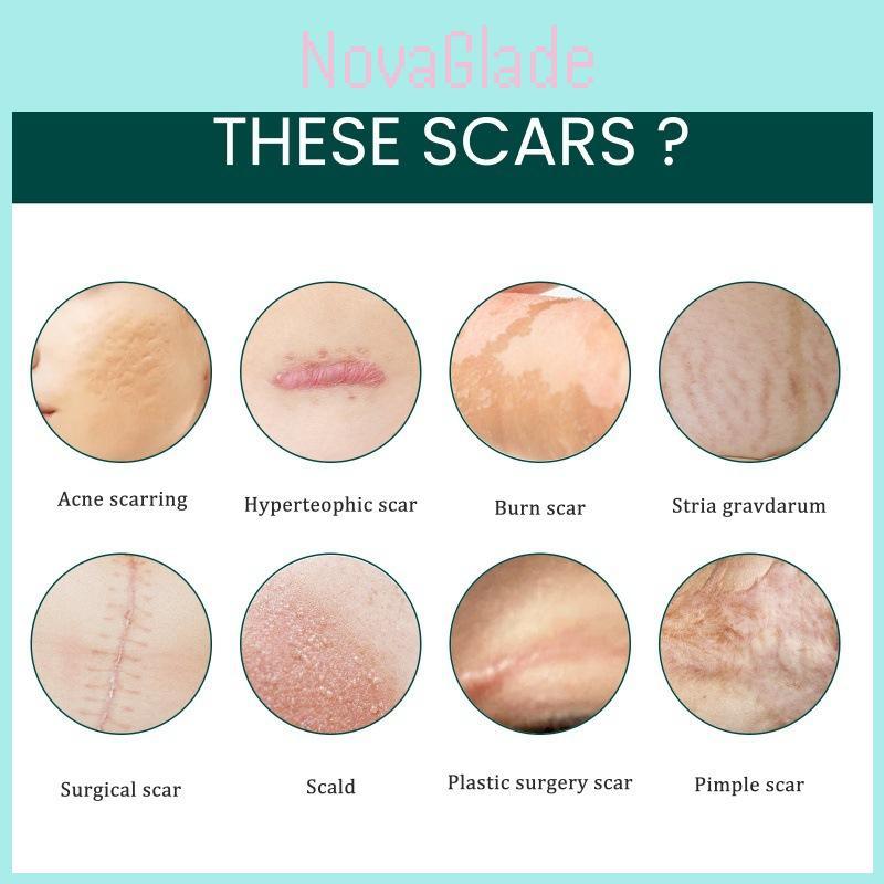 Eelhoe Silicone Scar Patch For Stretch Marks And Burn Scars Suitable For All Skin Types