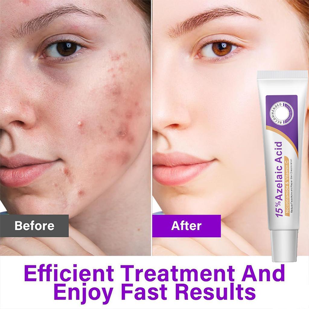 12% Azelainsäure Gesichtsserum Haut Hyaluron Und Beruhigend Und Aufhellend Den Hautton 20G