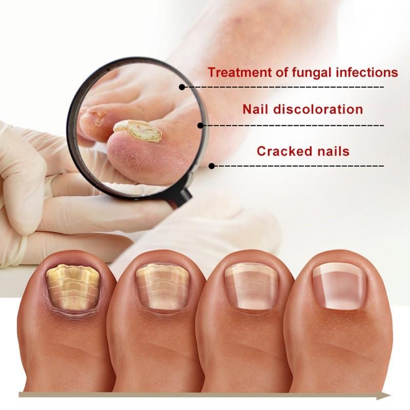 Essence de Réparation pour Ongles West Month Traitement Nourrissant pour Ongles et Orteils Endommagés 20ml