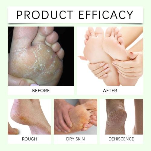 60% Urea Cream for Feet, Maximum Strength, for Dry, Cracked Feet and Hands, Softens, Deeply Moisturizes, and Relieves Cracked and Dry Skin (2 Pieces)