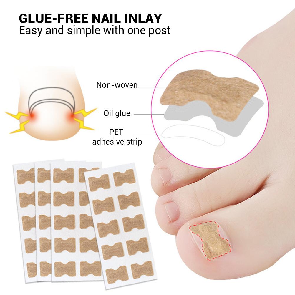 100 Stück eingewachsener Zehennagel Korrektur Aufkleber mit doppelseitigem Klebeband Paronychie Korrektur Pediküre Werkzeuge