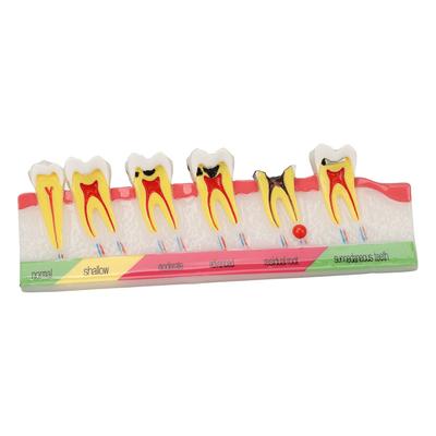 Dental Caries Model 6 Different Stages Resin Decayed Tooth Display Model