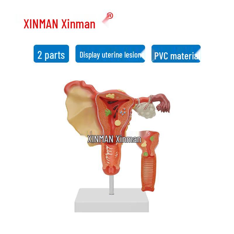 Xinman Pathological Uterine Anatomical Model