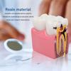 Dental Caries Model Tooth 6X Decay Demonstration Model for Teaching Study Laboratories