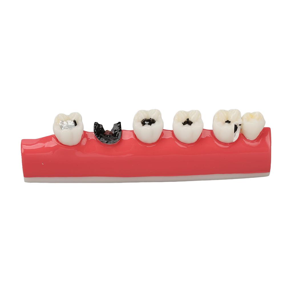 Dental Caries Model 6 Different Stages Resin Decayed Tooth Display Model