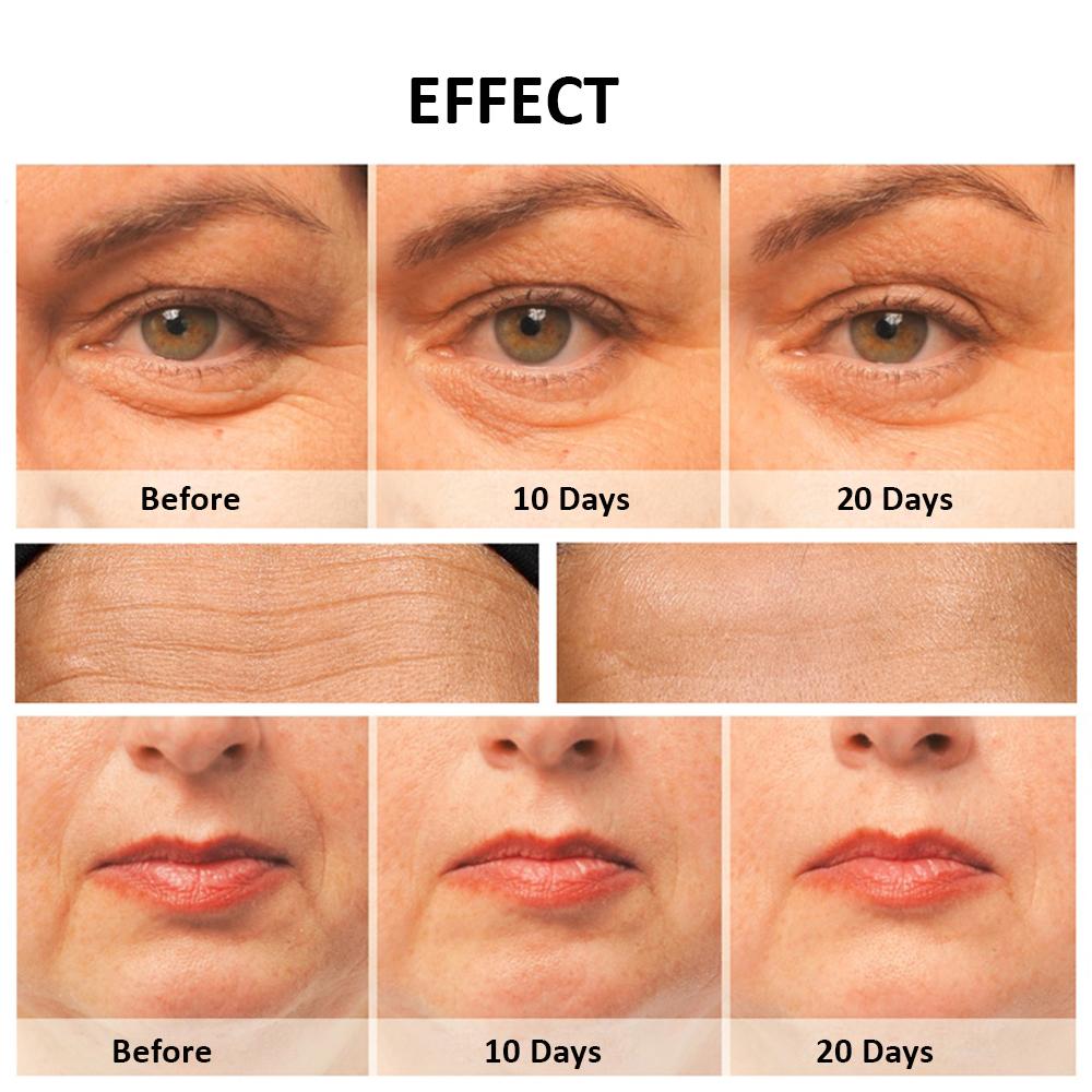 Skin Tightening Machine Radio Frequency Facial High Frequency Face Lifting Machine EMS Facial Microcurrent Skin Tightening Device