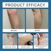 Varicose Vein Relief Cream Leg Massage Care Massage, Blue Veins And Red Blood Vessels  Varicose Veins,  Leg Fatigue And Soreness, Reduce Swelling A