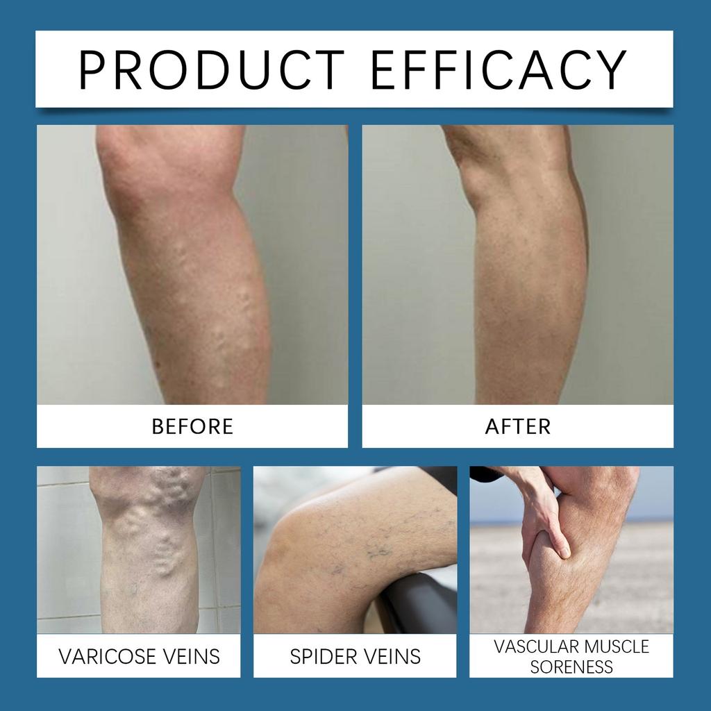 Varicose Vein Relief Cream Leg Massage Care Massage, Blue Veins And Red Blood Vessels  Varicose Veins,  Leg Fatigue And Soreness, Reduce Swelling A