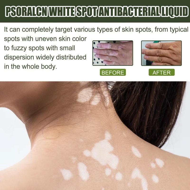 Eelhoe White Spot Repair Serum For Skin Brightening Moisturizing And Nourishing Care