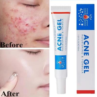 Effective Acne Removal Cream Anti-Acne Repair Redness Pimple Spots Gel Deep Cleaning Pore Oil Control Moisturizing Skin Care