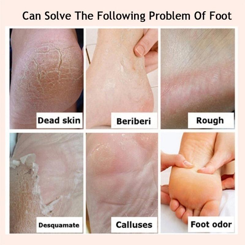 Effective Odor Treatment Nourishing Anti Cracking Cream Skin Care Products Dead Skin Remover Chapped Repair Cream