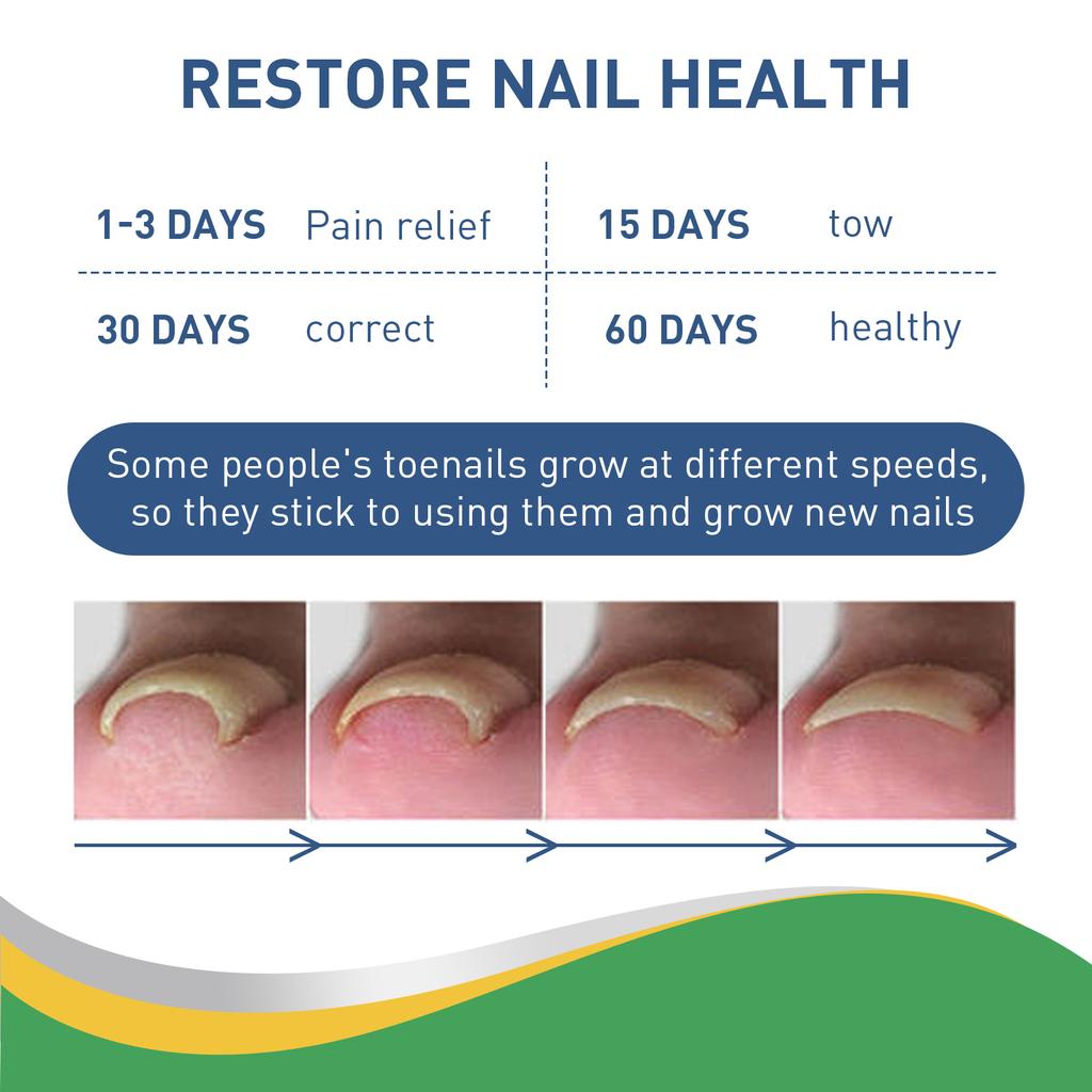50 Pcs/Set Nail Ingrown Stickers Double-sided Adhesive Ingrown Toenail Correction Ingrown Toenail Correction Tool Elastic Patch Stickers