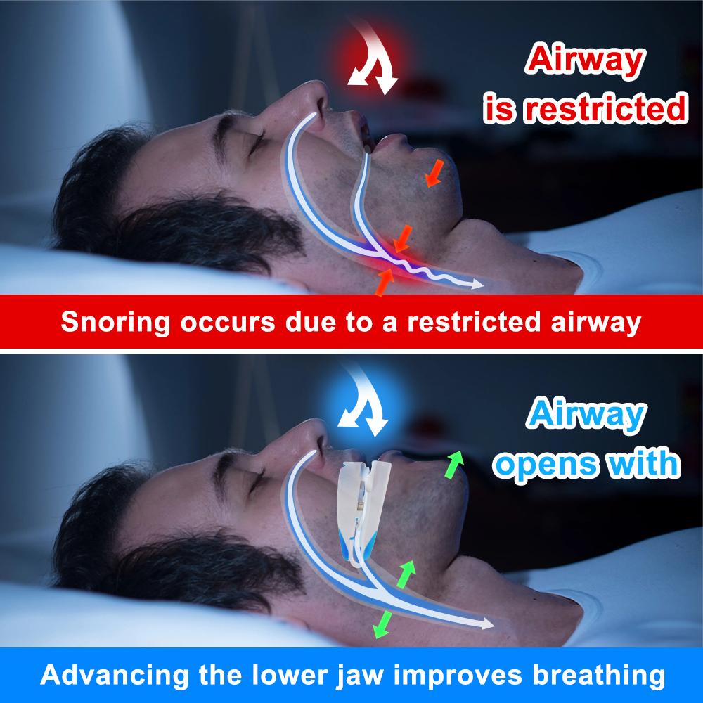 Adjustable Anti Snoring Mouth Guard Anti-Snoring Mouthpiece Sleeping Mouthpiece Device Bruxism Snoring Stopper Improve Sleep Aid