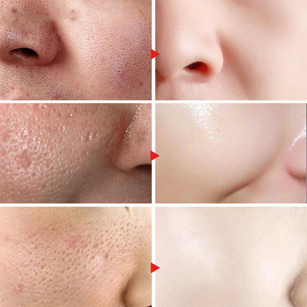 Facial whitening hyaluronic acid moisturizing serum, deep care and anti-wrinkle