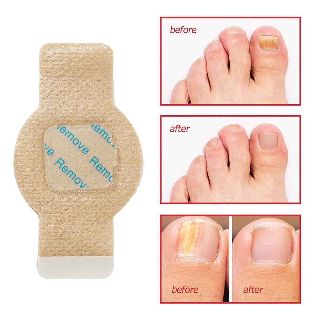 Fungal-Nail Patch Non-Irritation Strengthens Moisturizes Anti Toenail-Fungus Treat Sticker Quick Absorption Rehabilitation Patch