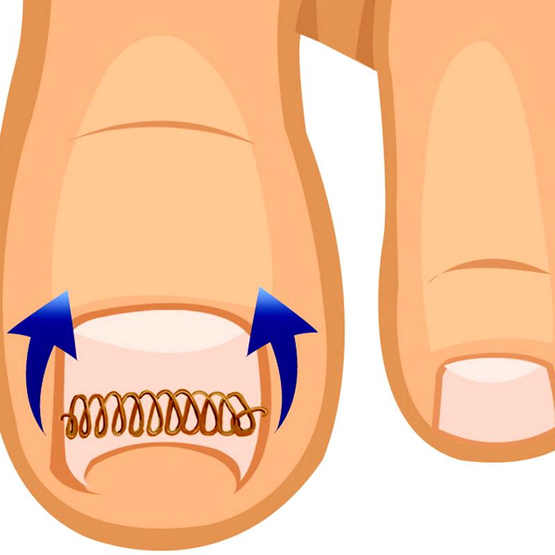 Ingrown Toe Nail Correction Wire Fixer Pedicure Paronychia Recover Toenails Corrector With Toe Correction Files Foot Care Tool