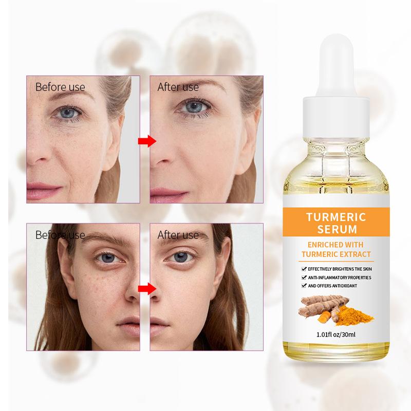 Gurkemeieessens lysner hudtonen og reduserer melasma