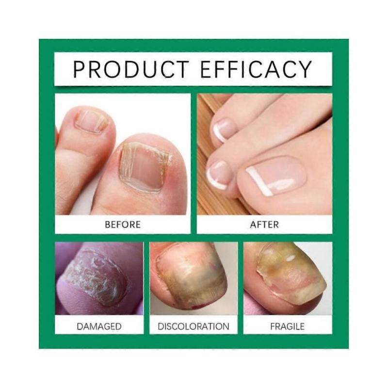 (1 st)1-3X Nail shield ANTI-FUNGAL STICK Nailshield Anti Fungal Stick, Monsalife Nail Shield Anti Fungal Stick