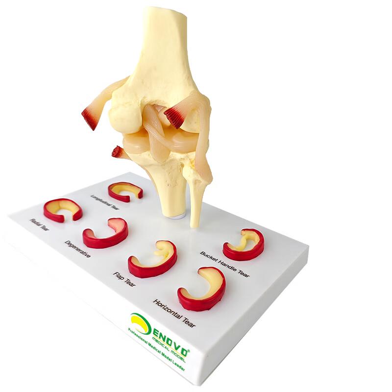 ENOVO Medical Functional Knee Joint Model
