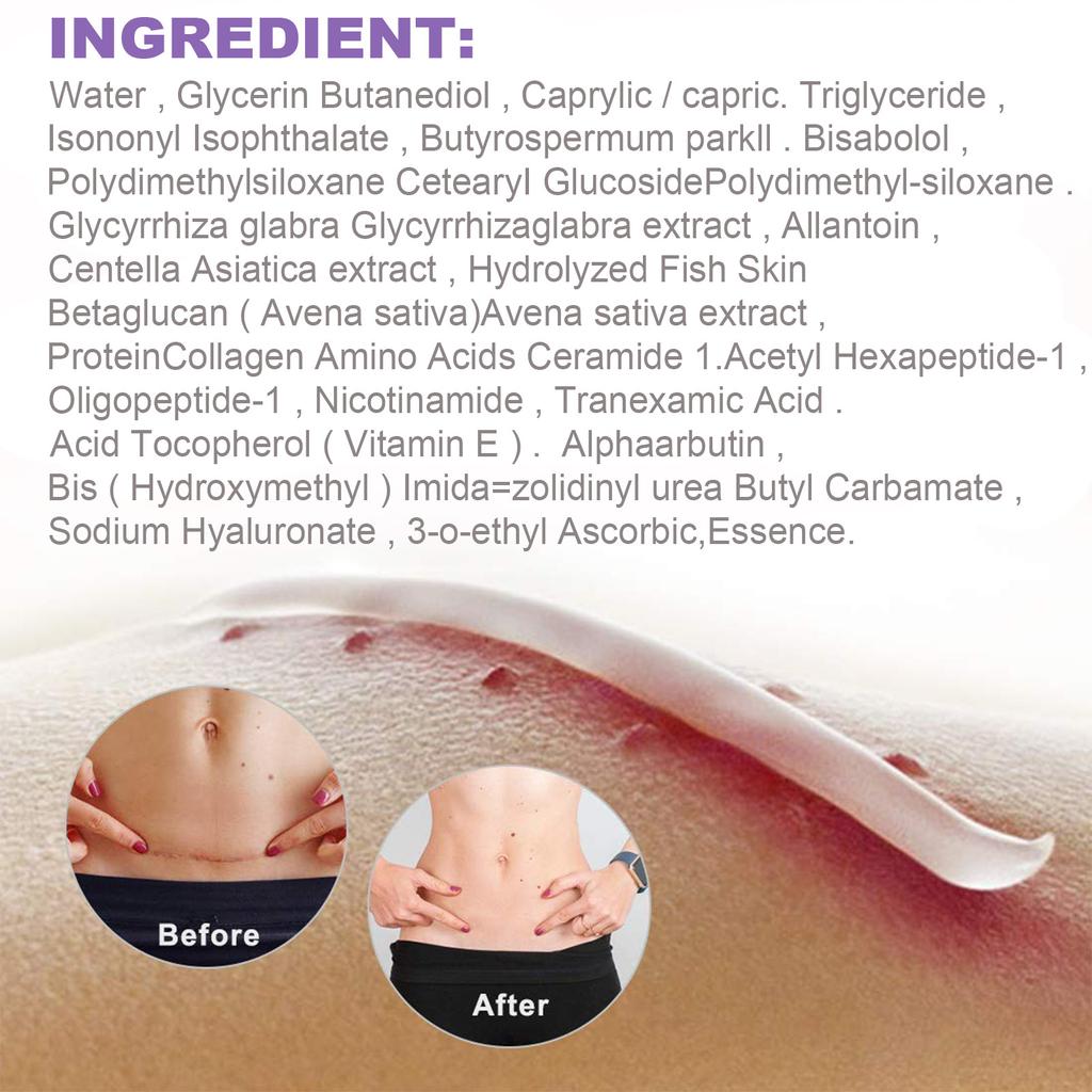 EELHOE Scar Removal Cream Gel Remove Acne Spots Treatment Stretch Marks Burn Surgical Scar Repair Cream Smoothing Whitening Skin Beauty 50g