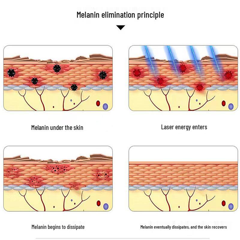 PicoSecond Laser Beauty Device for Spot, Freckle, Mole, Tattoo Removal, & Non-Invasive Brow Wash