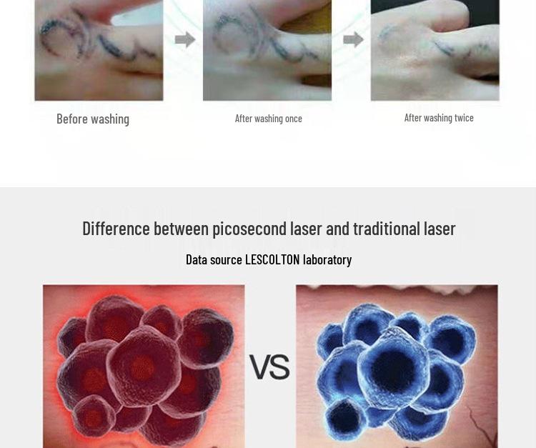 Portable Picosecond Laser Pen for Tattoo, Freckle, and Eyebrow Removal with Red & Blue Light