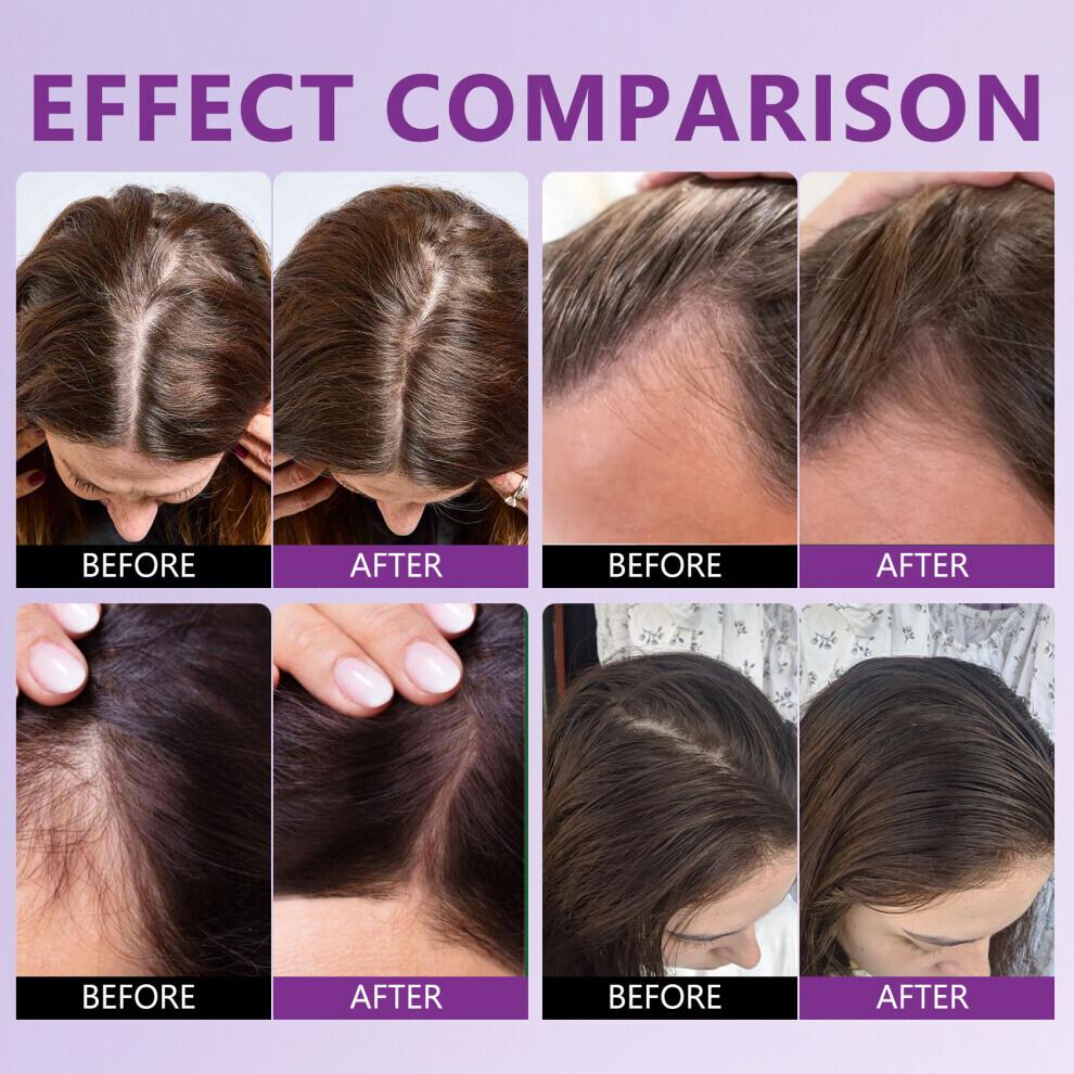 2 Stück 60 ml Minoxidil 5% Rosmarin & Biotin Haarspray Haarwachstumsspray