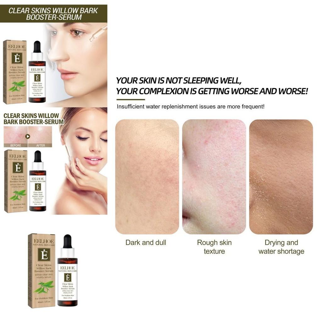 Eelhoe Clear Skin Willow Bark Essence Nourishing Moisturizer For Dry Skin And Acne Scars