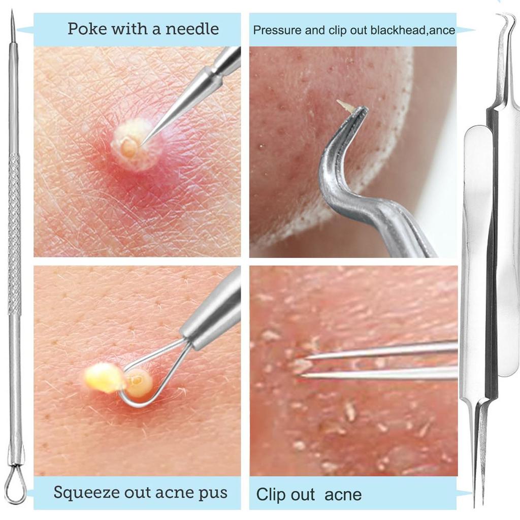 Blackhead Remover Comedone Squeezer Set Stainless Steel Pimple Squeezer Tool Acne Pimple Tweezers for Nose Face Care