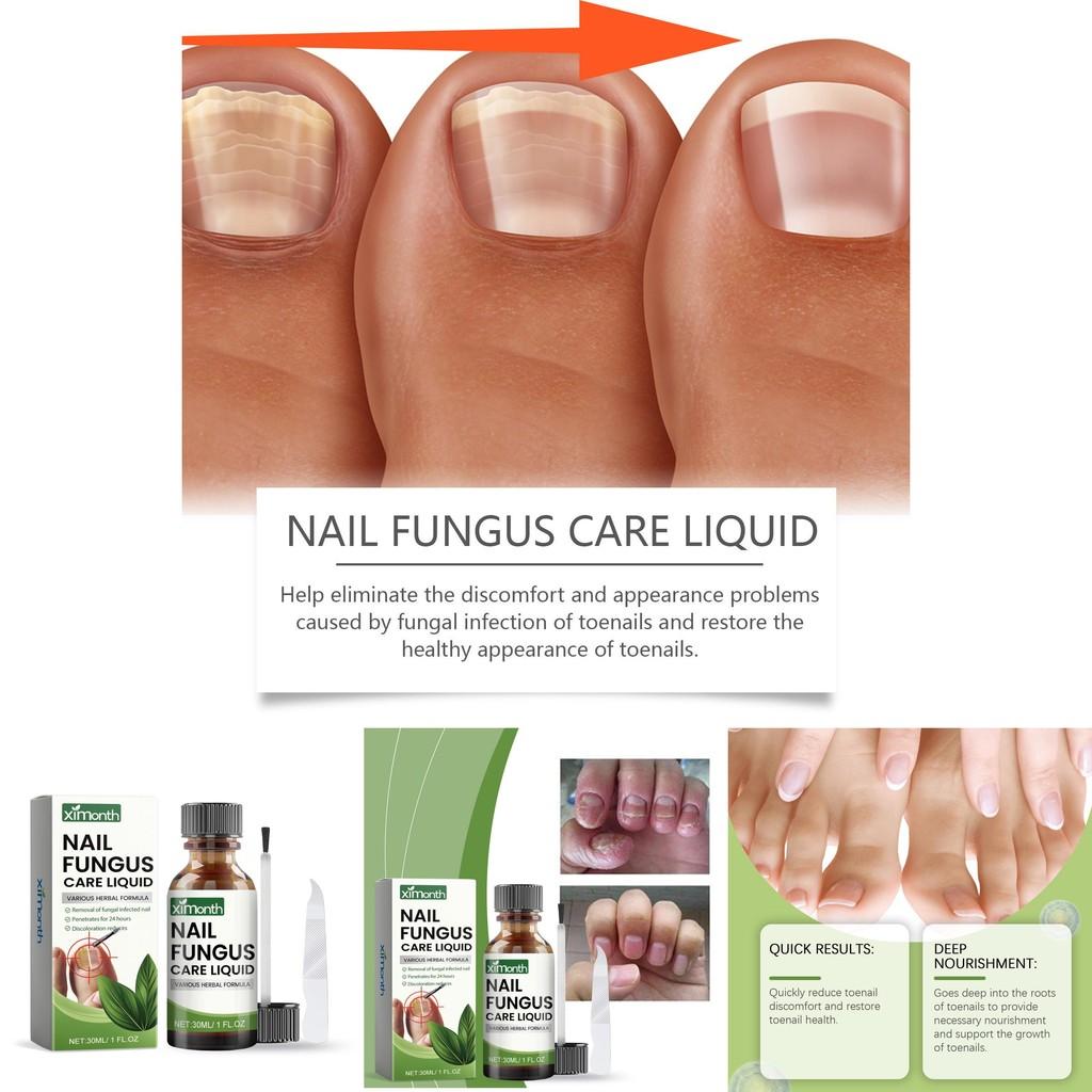 Conjunto Avançado Ximonth para Reparação de Unhas dos Pés e das Mãos para Cuidado de Unhas Saudáveis e Bonitas