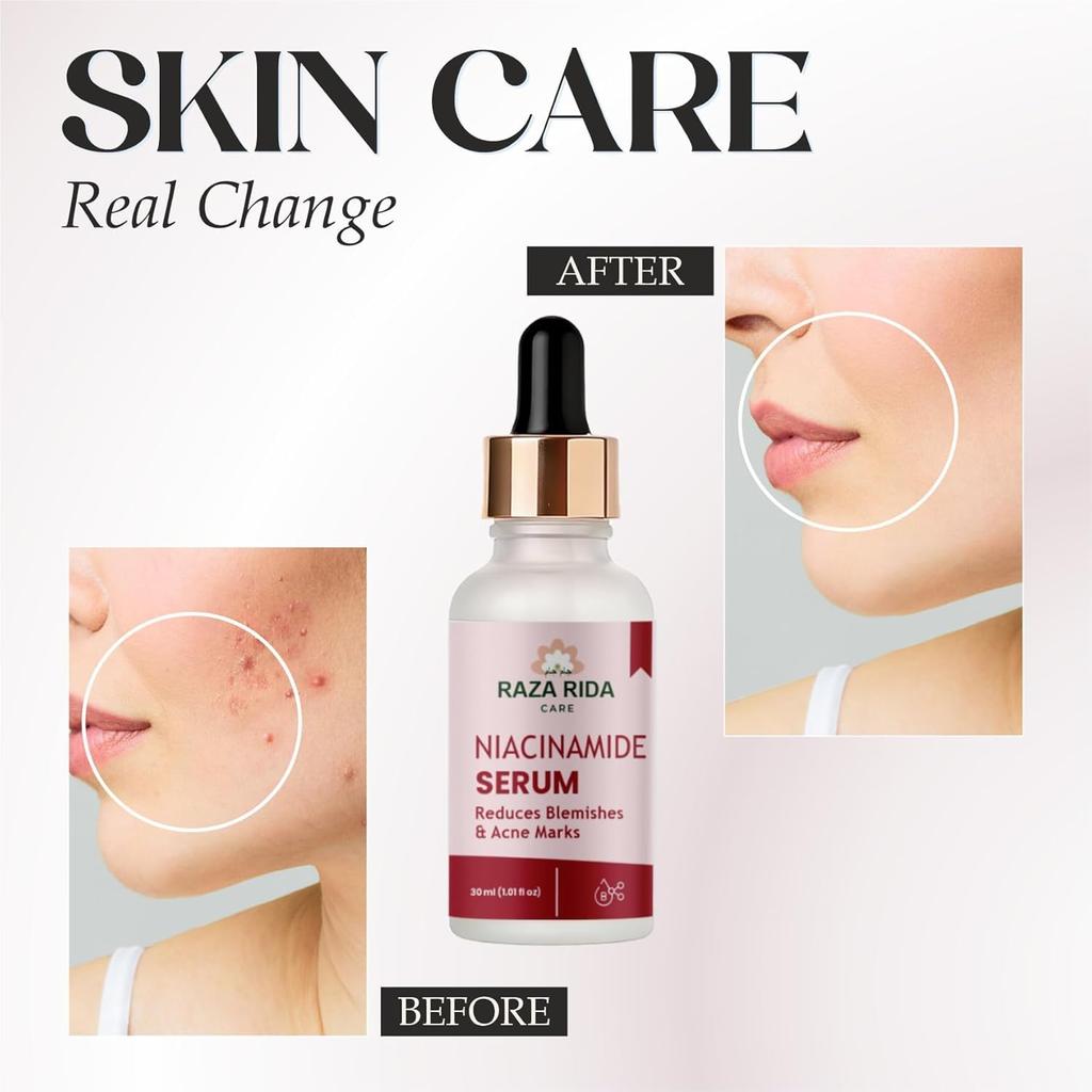 Raza Rida Care Niacinamide Serum, Reduces Blemishes & Acne Marks, 30ml (1.01 Fl Oz)
