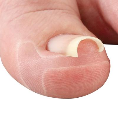 Cyplus Transparent Ingrown Nail 50 Thin Transparent Transparent Double Does Not Enter Claw Guards From Nail Pressure Miene Tape, Pieces, Plate, Film,