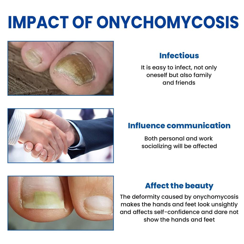 Tånagelsvampsplåster, Nattnagelvårdsplåster, Snabba nagelvårdsplåster, Minska Onychomycosis Och Mjuka Naglar (32 st/kartong) 2 st