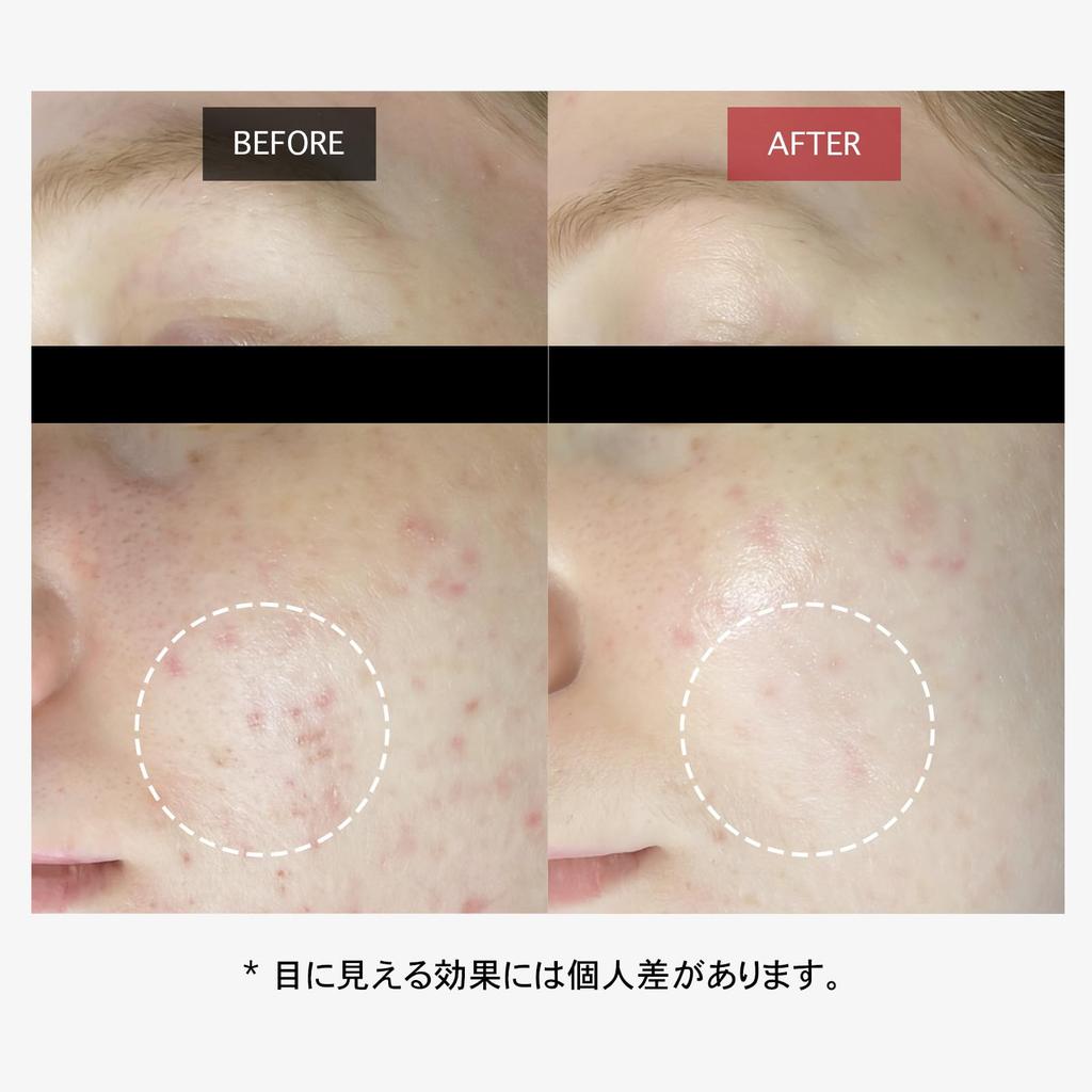 Want Red BHA Tea Salicylic Pore Blackhead Korean Skincare Dr. Gel, 100g, Tree, Acid, Exfoliating, Cleansing, Removal, Dr. Want,