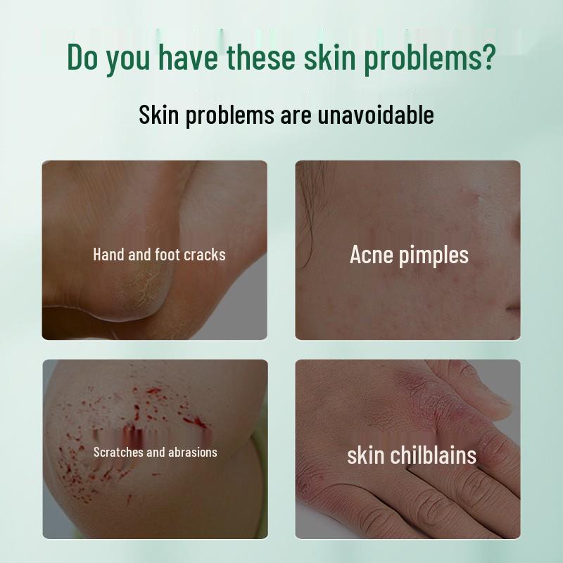 Tuo Neng Skin Care Ointment: Protects Against Acne, Dermatitis, Eczema, Non-Chronic Wounds, Cracks, and Chilblains.