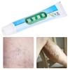 Phlebitis Varicose Vascular Inflammation Ointment Veins Collapse Treatment Cream