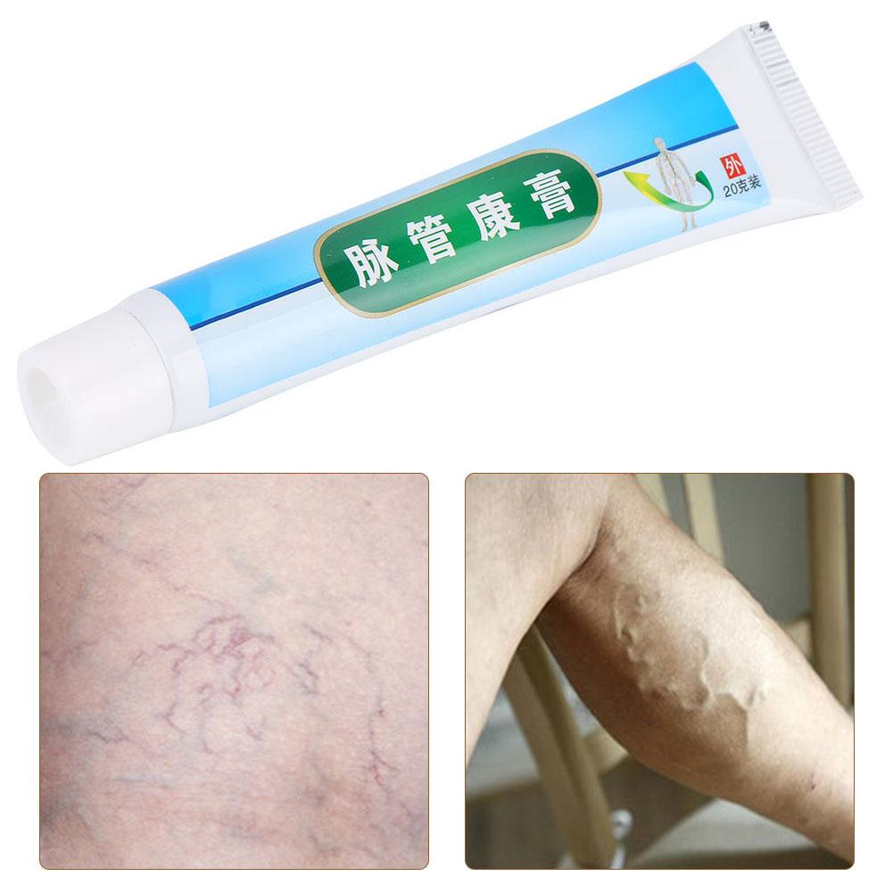 Phlebitis Varicose Vascular Inflammation Ointment Veins Collapse Treatment Cream