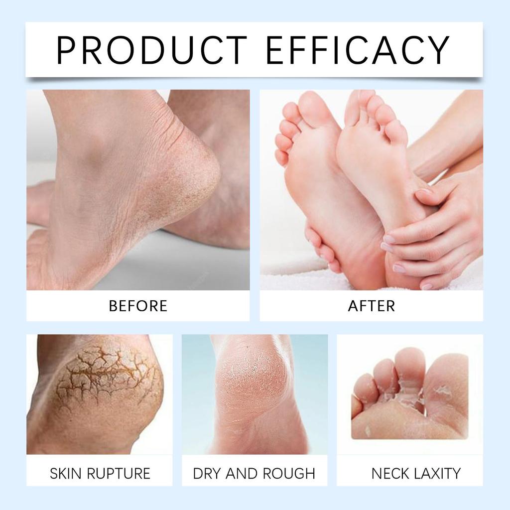 Wiyun Urea Moisturizing Foot Repair Cream Nourishing Foot Moisturizer with Urea Gentle Care for Soft Feet 100g