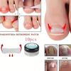 1box Nail Patch Nail Groove Inlay Corrector for Toenail Repair Quick Adhesive Strip