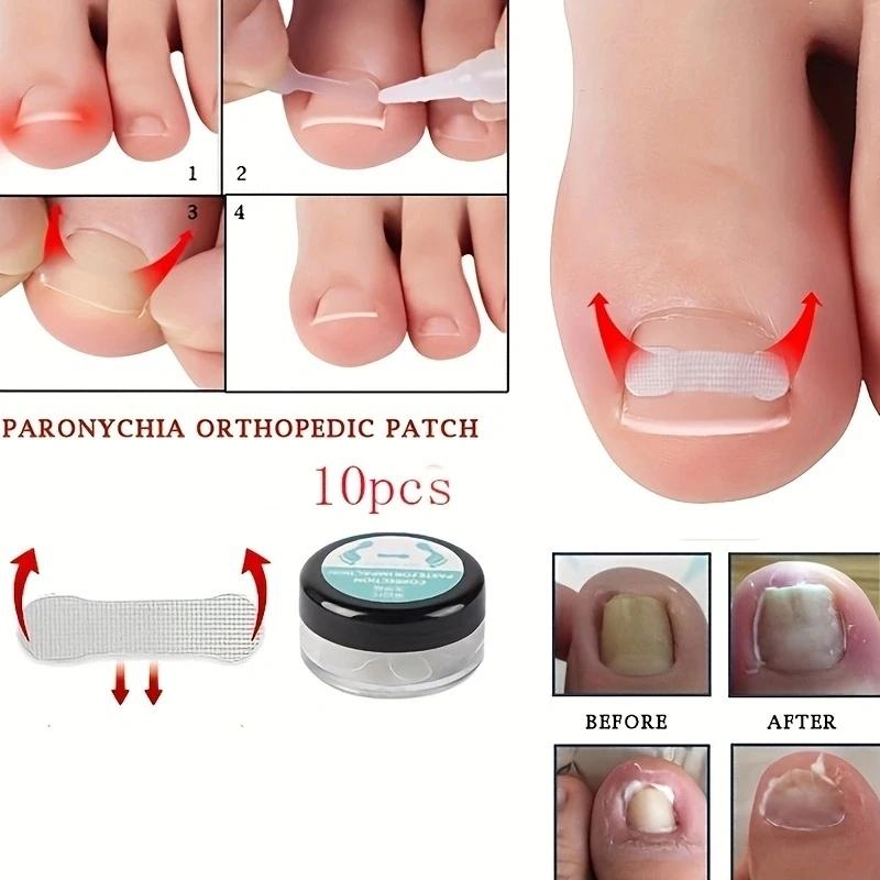 1box Nail Patch Nail Groove Inlay Corrector for Toenail Repair Quick Adhesive Strip