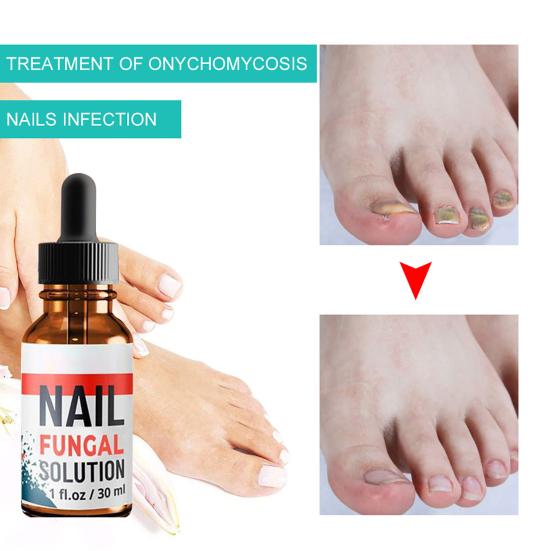 10ml/20ml/30ml Anti Fungus Liquid Toe Finger Nail Infection Repair Treatment