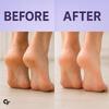 Carbamide Forte 20% Urea Foot Cream Roll-On 50ml For Cracked Heels Moisturising & Repairing Pack of 2
