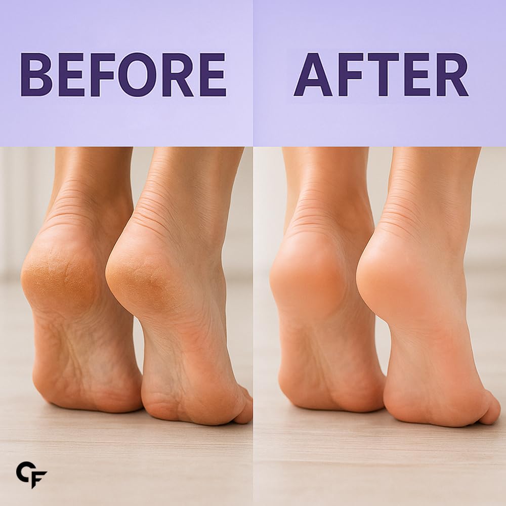 Carbamide Forte 20% Urea Foot Cream Roll-On 50ml For Cracked Heels Moisturising & Repairing Pack of 2