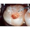GDC Endo Spoon Excavator - 6 Excgl2