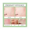 Anua Azelaic Acid 10 Hyaluron Redness Soothing Serum, Facial Serum for Sensitive Skin, Hyaluronic Acid, Niacinamide, Spot Care