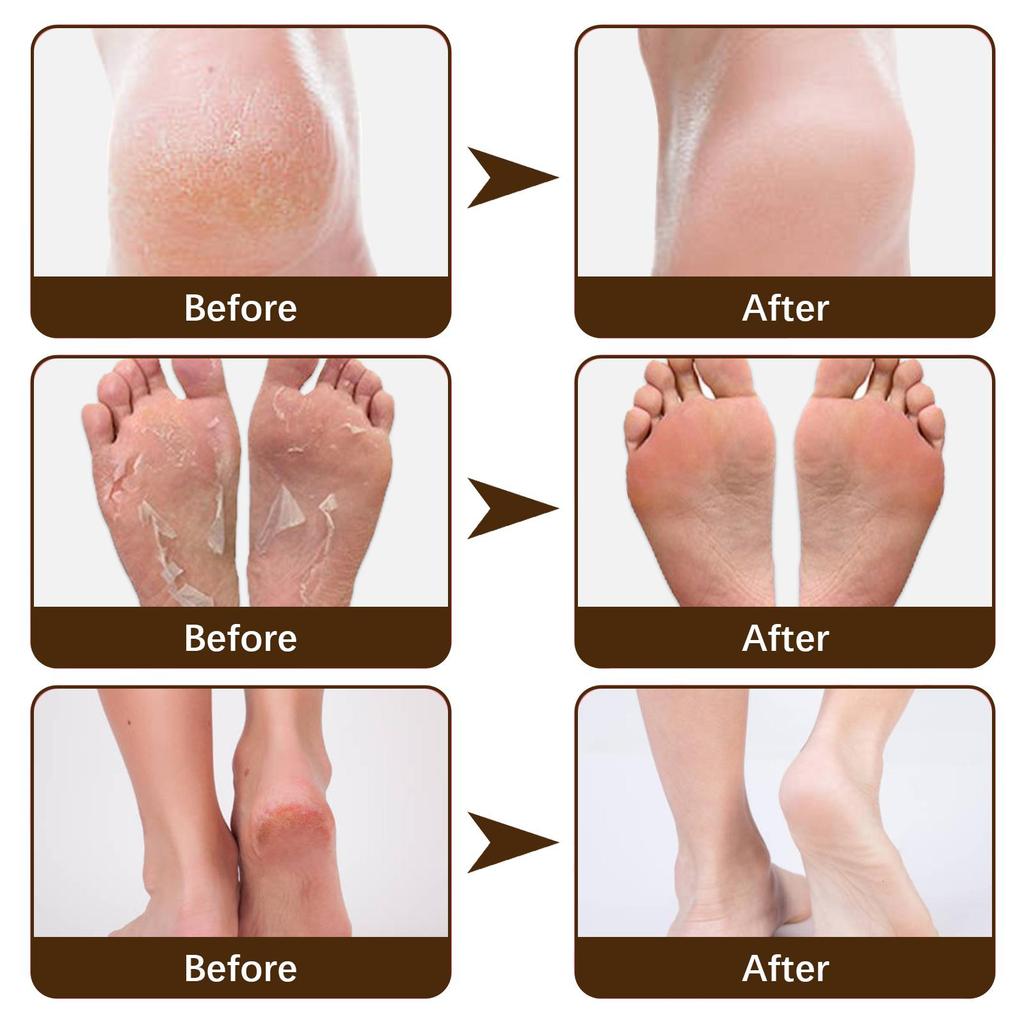 15g Cracked Heel Treatment Cream Repairing Feet Anti-Dry Cracked Peeling Chapped Moisturizing Foot Cream