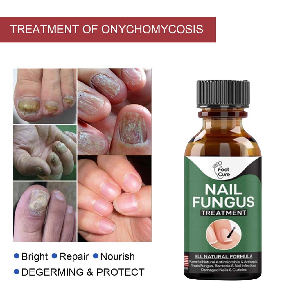 50ML Nail Treatment Solution Nail Repair Liquid Accelerate Metabolism Onychomycosis Treatment